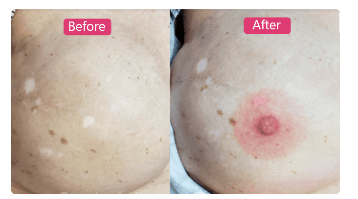 Areola reconstruction: how micropigmentation changes lives
